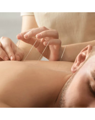 akupunkturos procedura