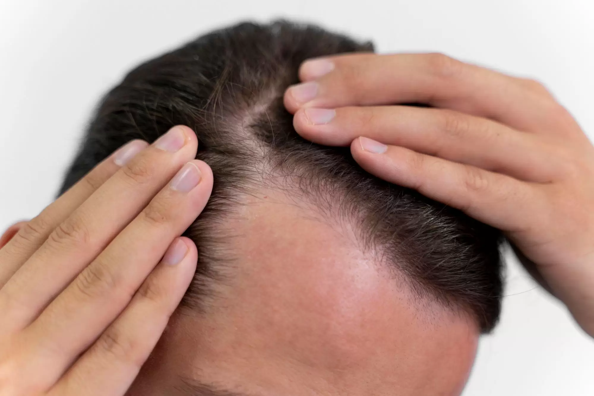 Inovacija plaukų slinkimo gydyme! FOTONA HAIRestart® lazerinė procedūra